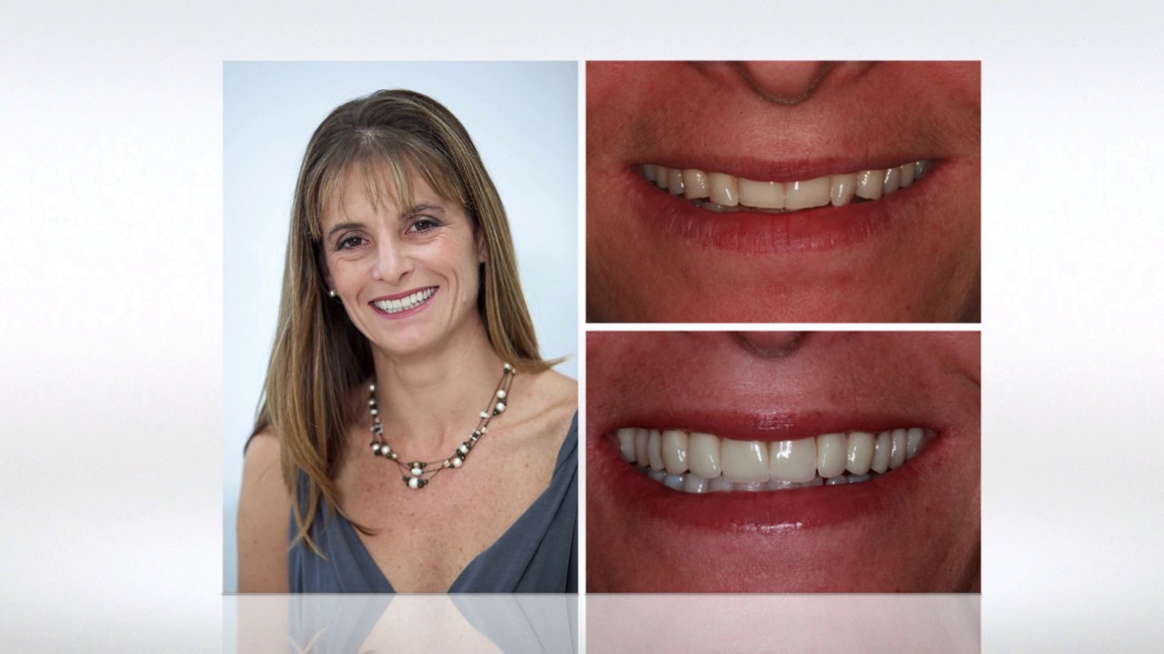 ≫ How Much False Teeth Cost In South Africa The Dizaldo Blog!
