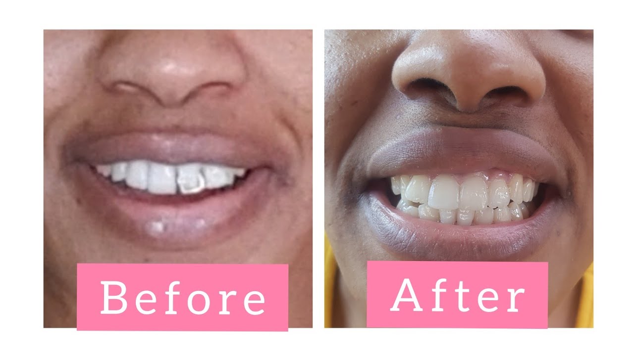 ≫ How Much To Remove Tooth In South Africa The Dizaldo Blog!